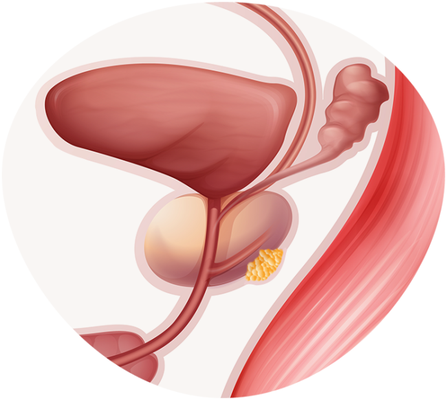 câncer de próstata sintomas prostatectomia cirurgia câncer de próstata tem cura tratamentos medico especialista urologista