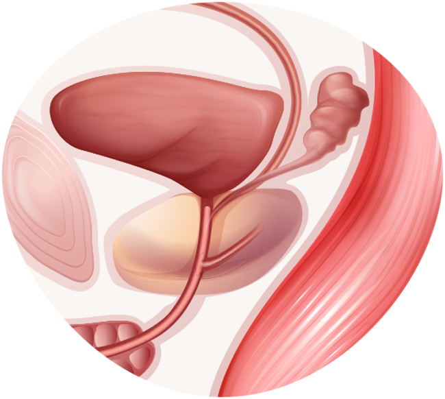 Próstata Aumentada (Hiperplasia Prostática) - Médico Especialista SP