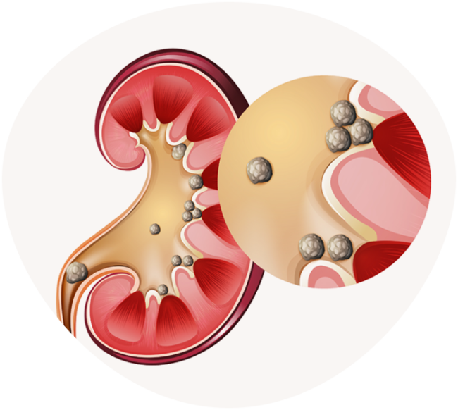 Tratamentos para Cálculo Renal Especialista São Paulo - SP
