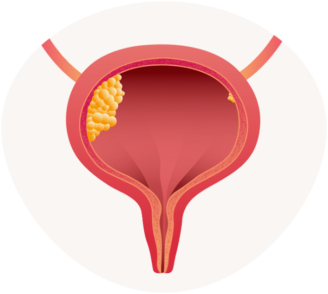 Câncer de Bexiga - Tratamento com Urologista Oncologista SP