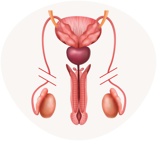 Cirurgia de Vasectomia - Médico Especialista SP