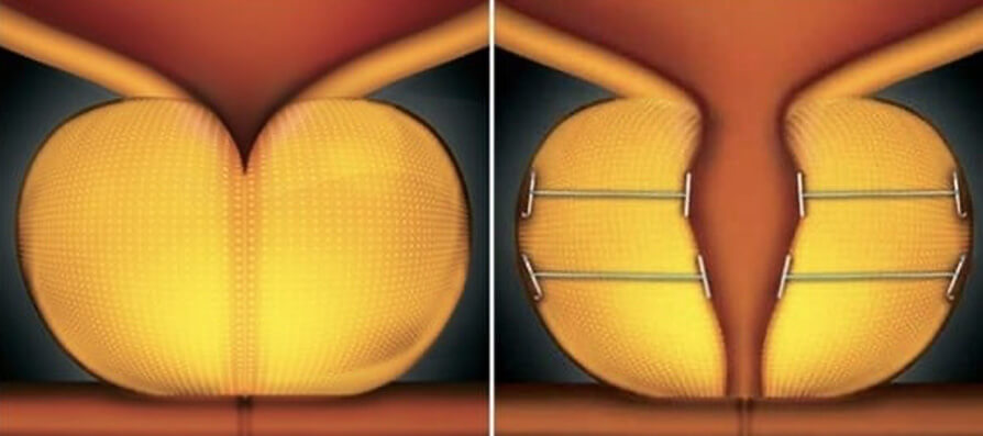 Urolift