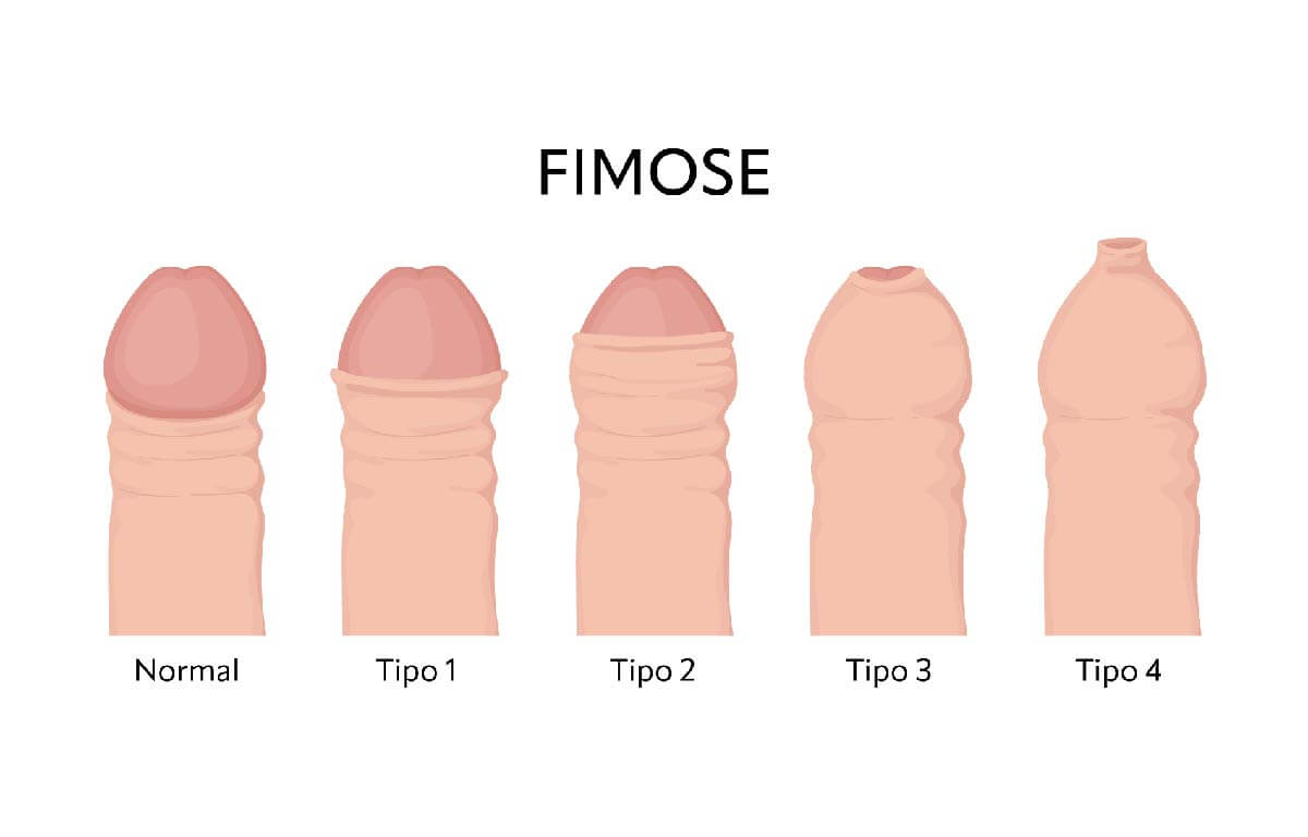postectomia cirurgia de fimose