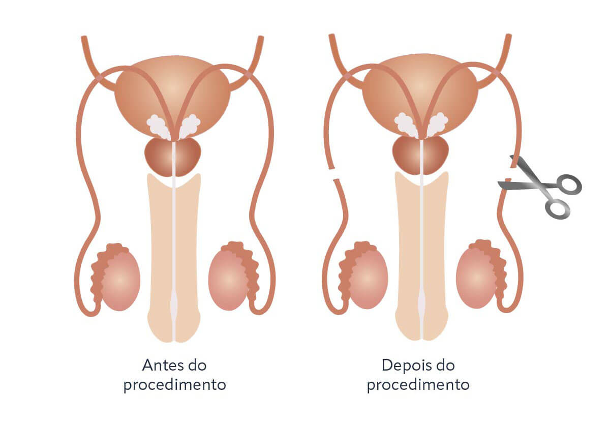 Vasectomia: O que É? É Reversível? Qual o Valor? Como Funciona? Como É a Recuperação? Qual Médico Faz Cirurgia de Vasectomia em São Paulo SP?